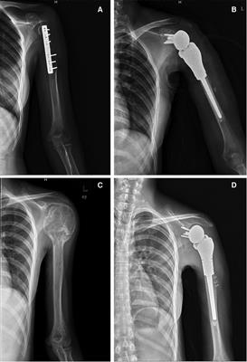 Early functional and therapeutic effect of reversed tumour shoulder prosthesis reconstruction after proximal humerus tumour resection